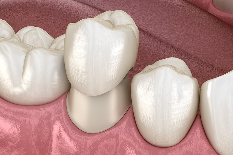 Zirconia Crowns