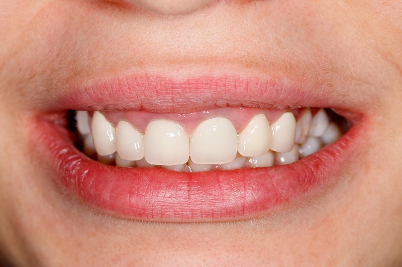 Patient with Zirconia Crowns
